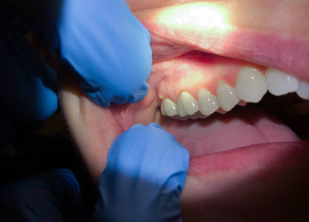 Best Tooth Infection Emergency Dentist  in Cave Spring, VA